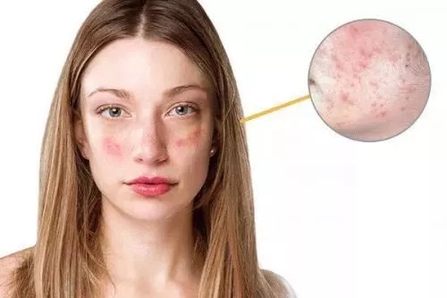 春季過敏不止你一個(gè) 預(yù)防要專業(yè)！